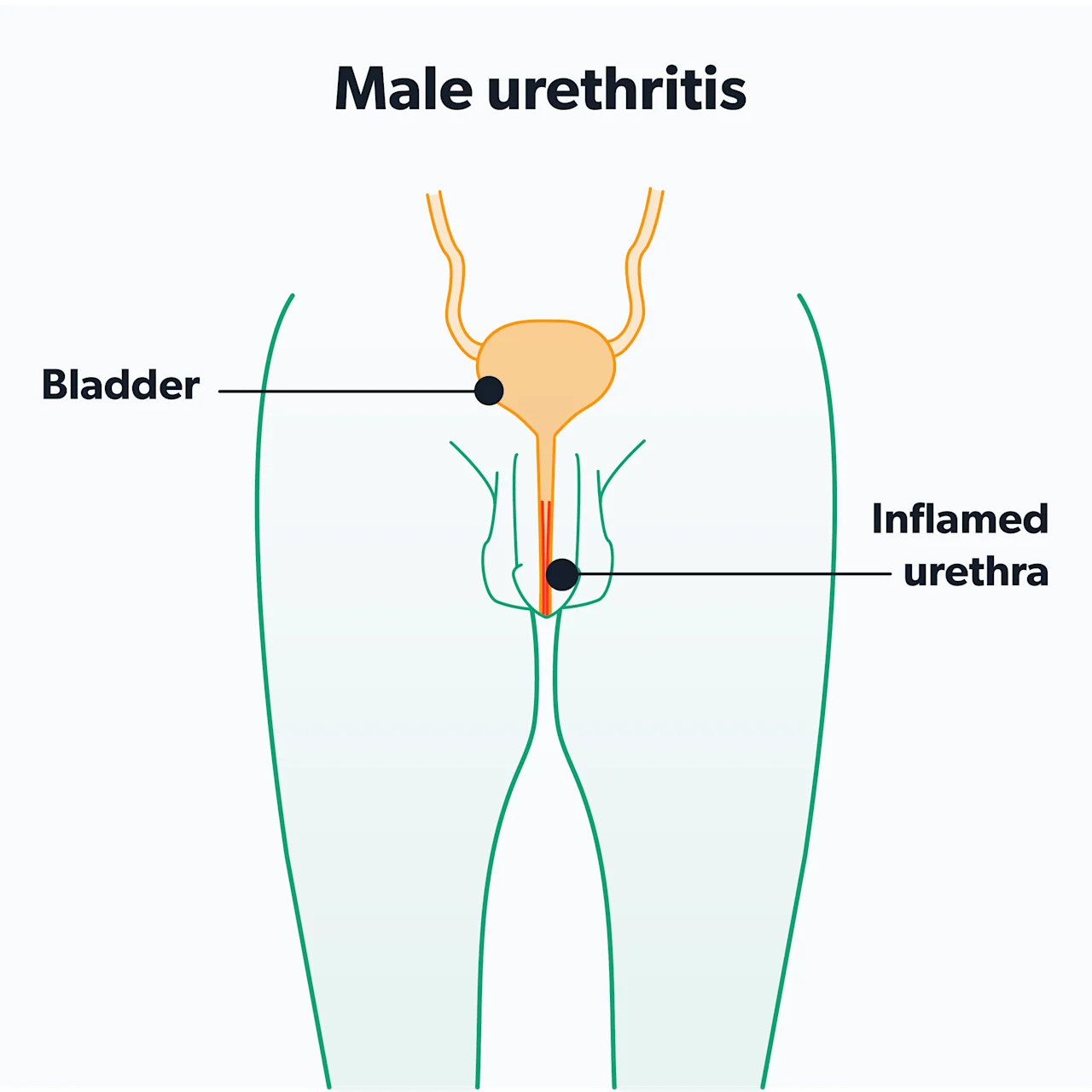 OC Chlamydia and men: signs, diagnosis, and treatment image 144c921e-751f-4bf3-b8fd-5af6e68e5631