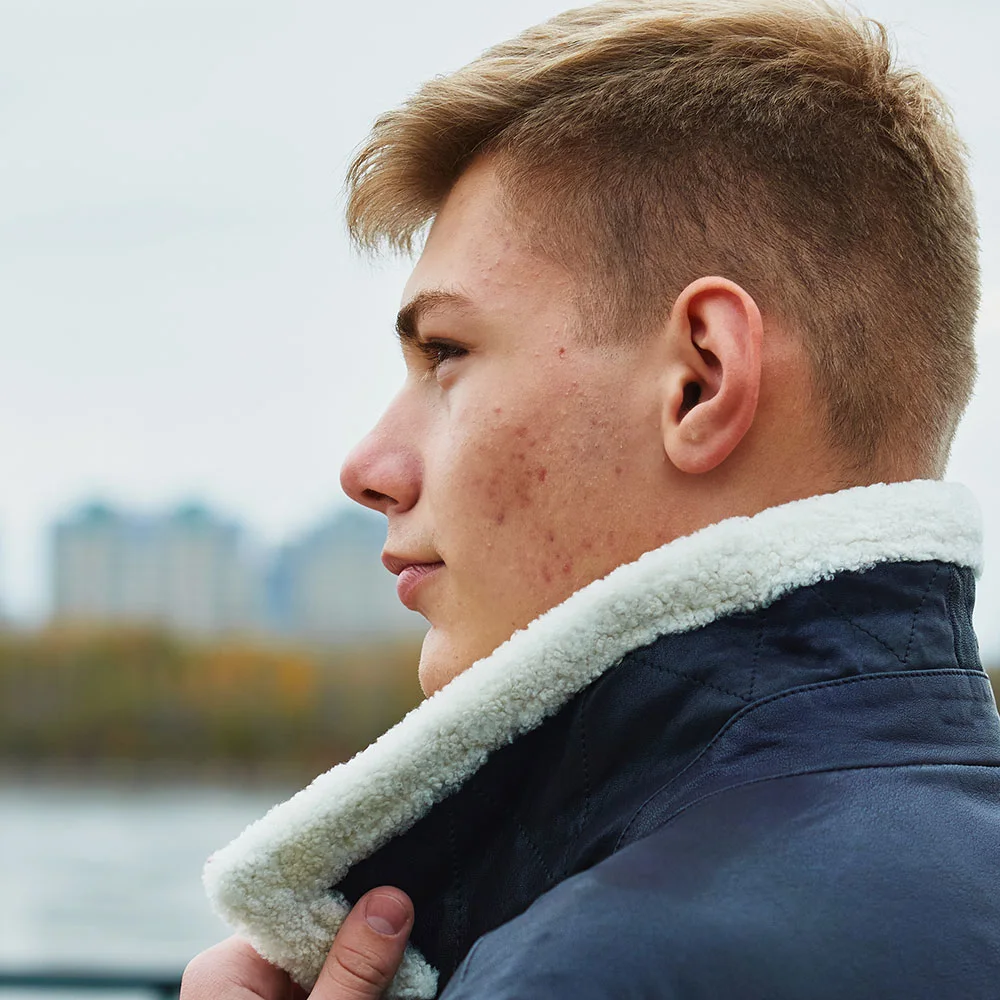 Skin purging: what is it, process, how long does it last - Desktop Image