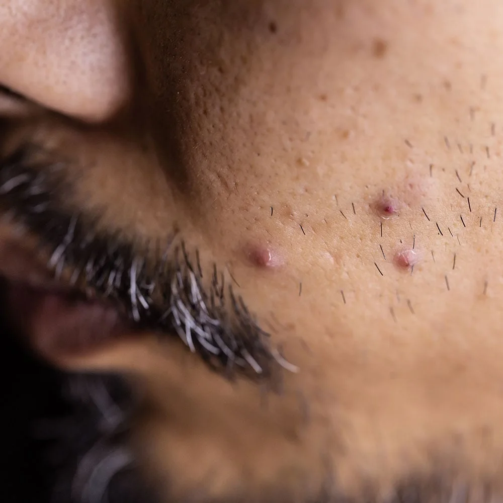 Accutane: what is it, how does it work, risks - Desktop Image