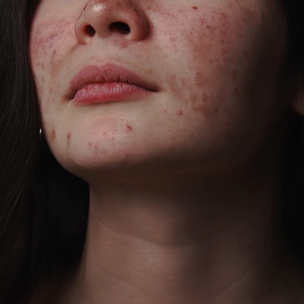 Adult acne: symptoms, causes, and treatments - Desktop Image