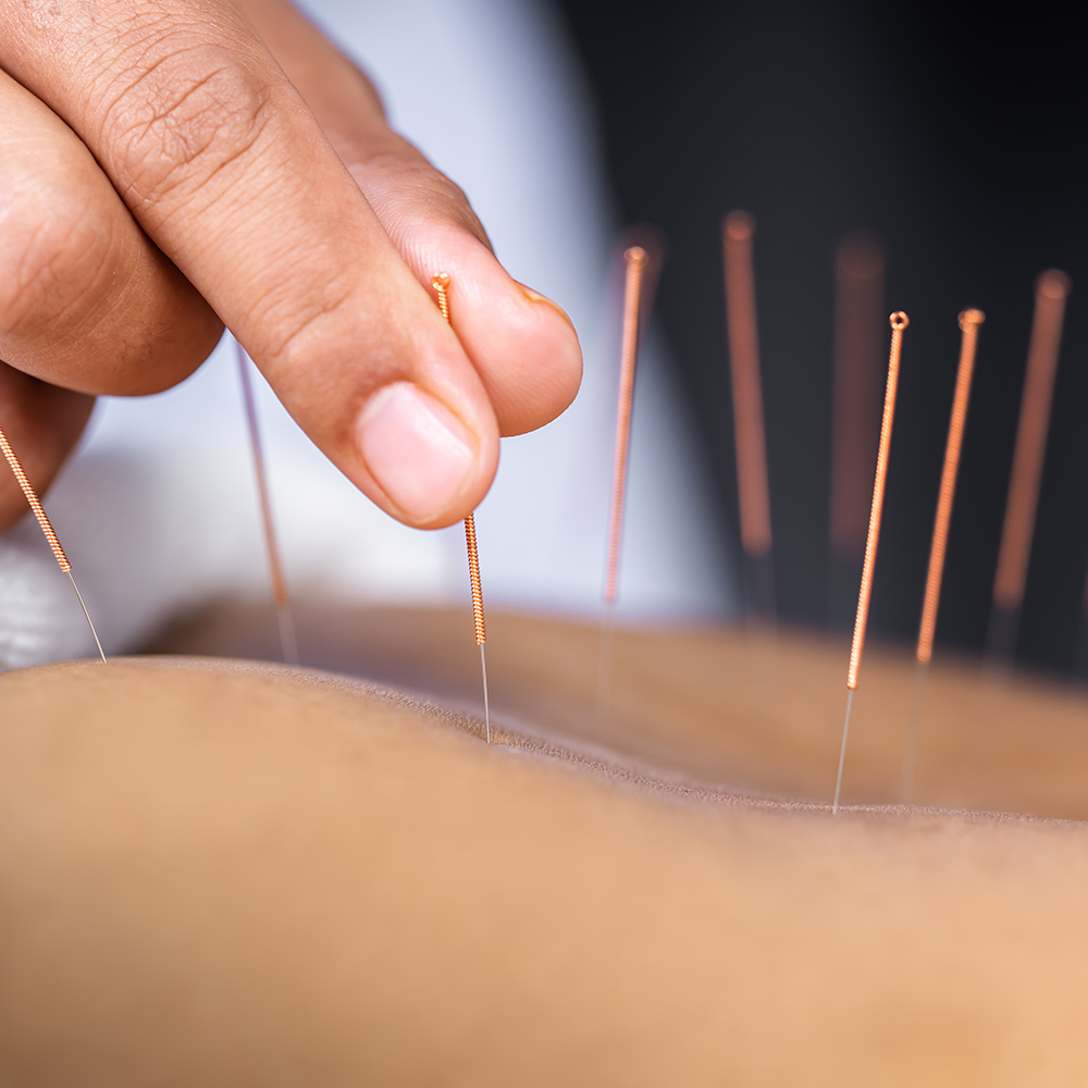 Acupuncture What Is It Does It Work Benefits Cost Ro