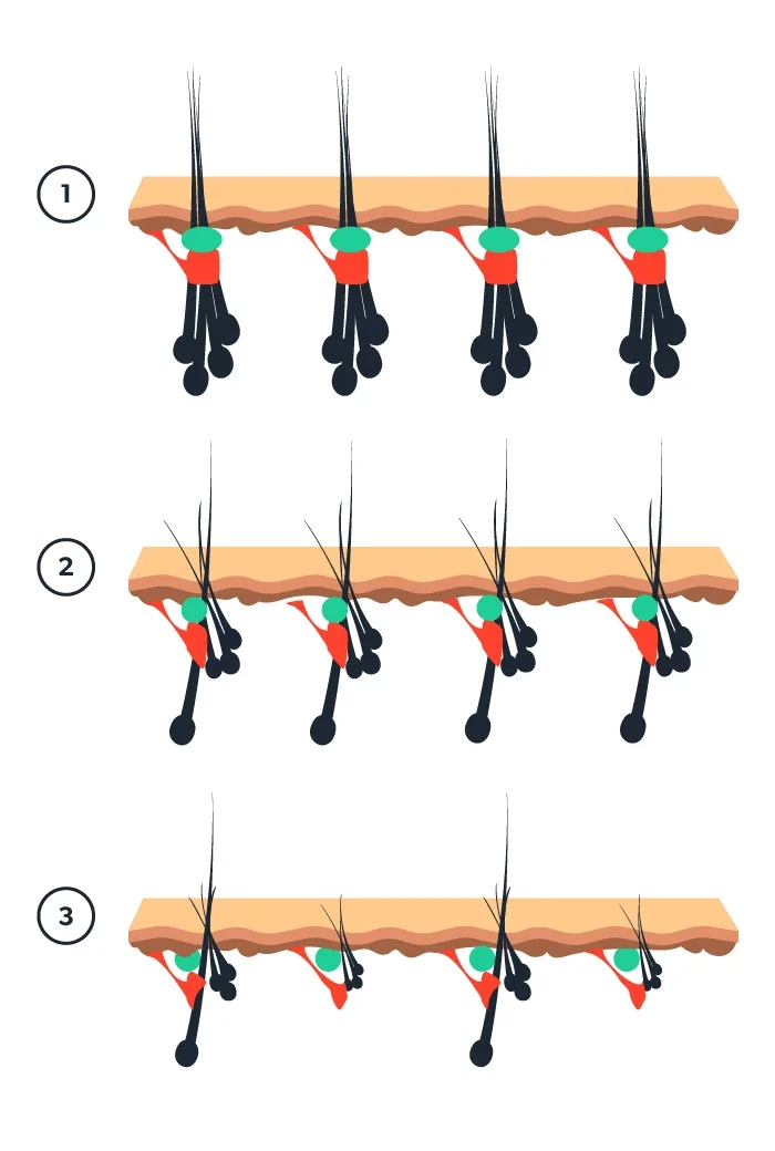 Finasteride and hair loss
