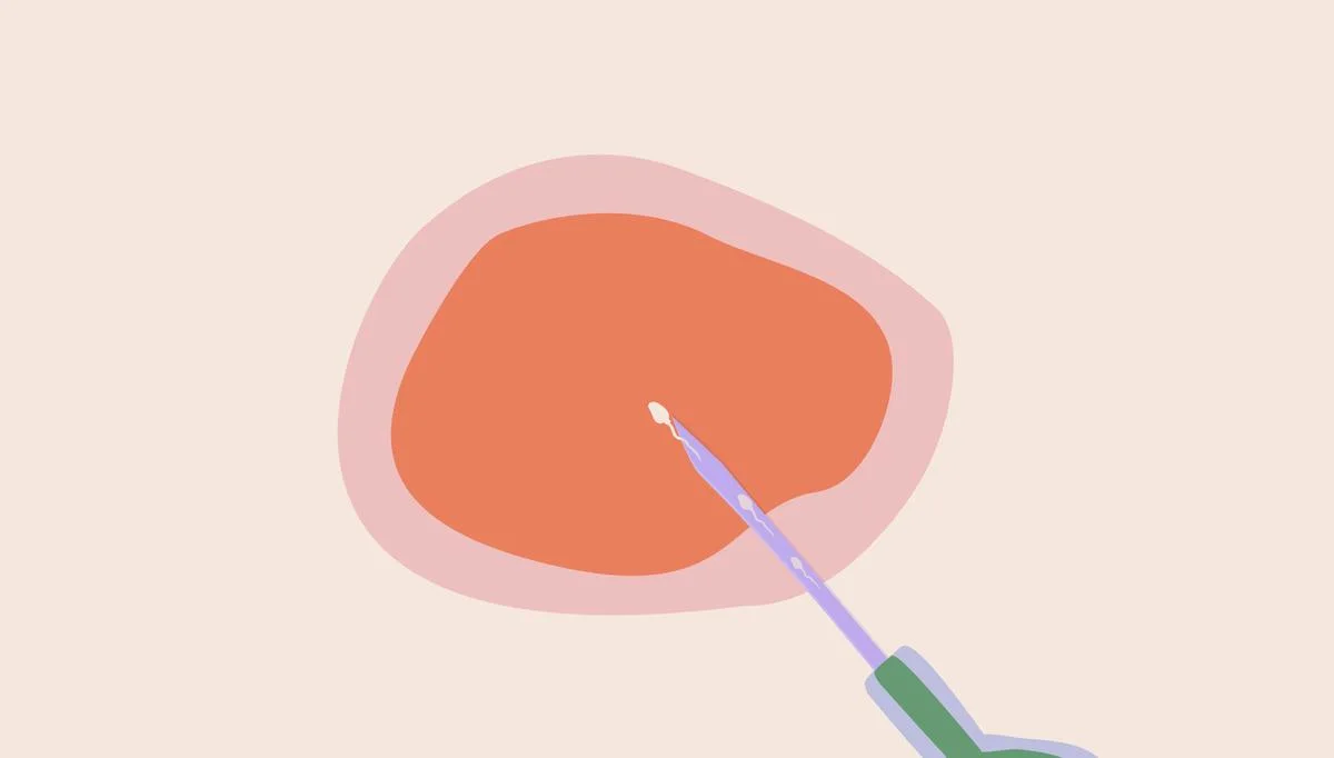 ICSI: When IVF needs a boost - Desktop Image