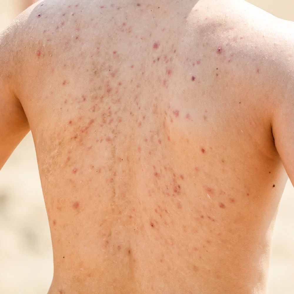 Body acne: causes, treatments, how to get rid of it - Desktop Image