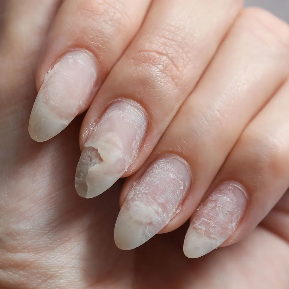 Learn about nail psoriasis | Vinmec