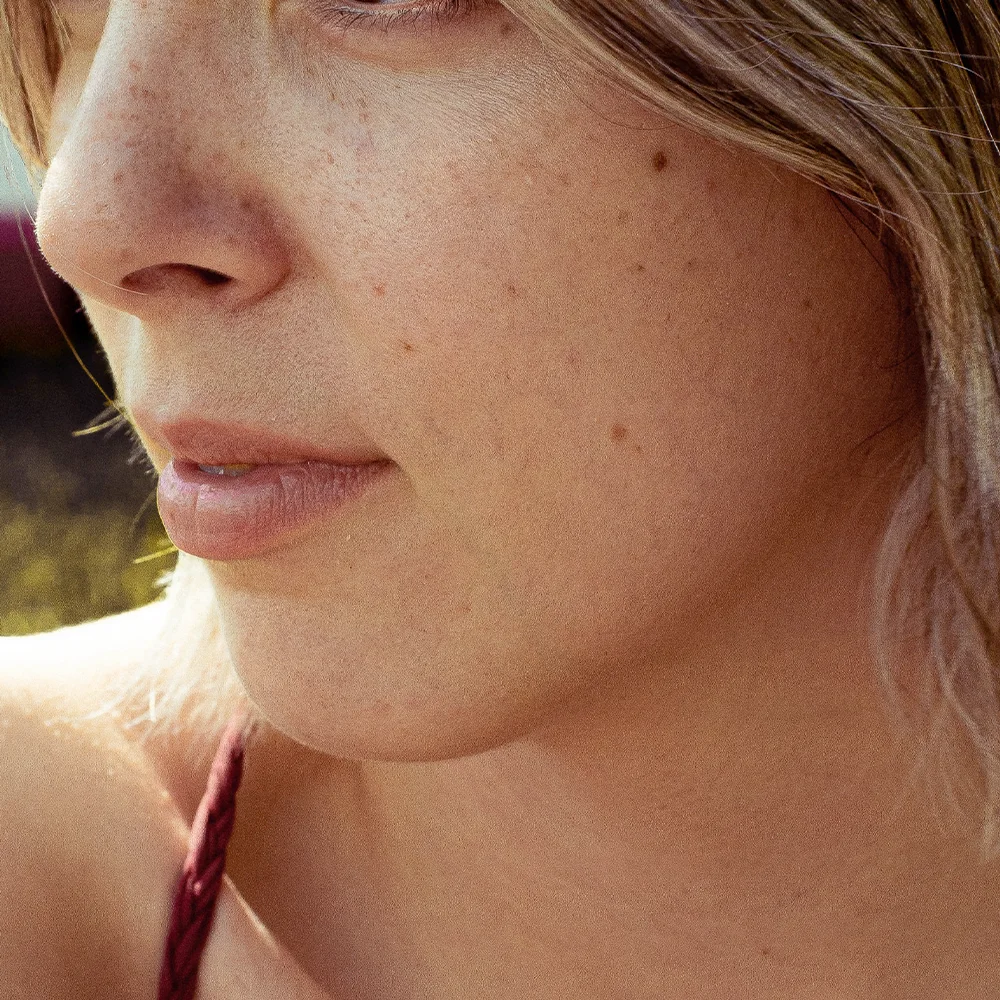 Hormonal acne: causes, types, treatment - Desktop Image