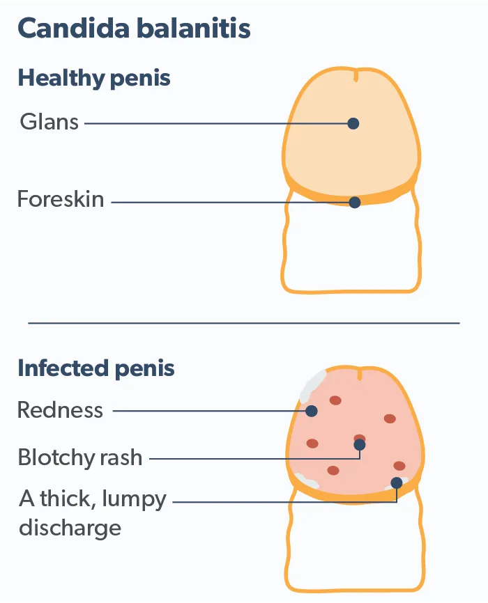 Balanitis causes and treatments diagram