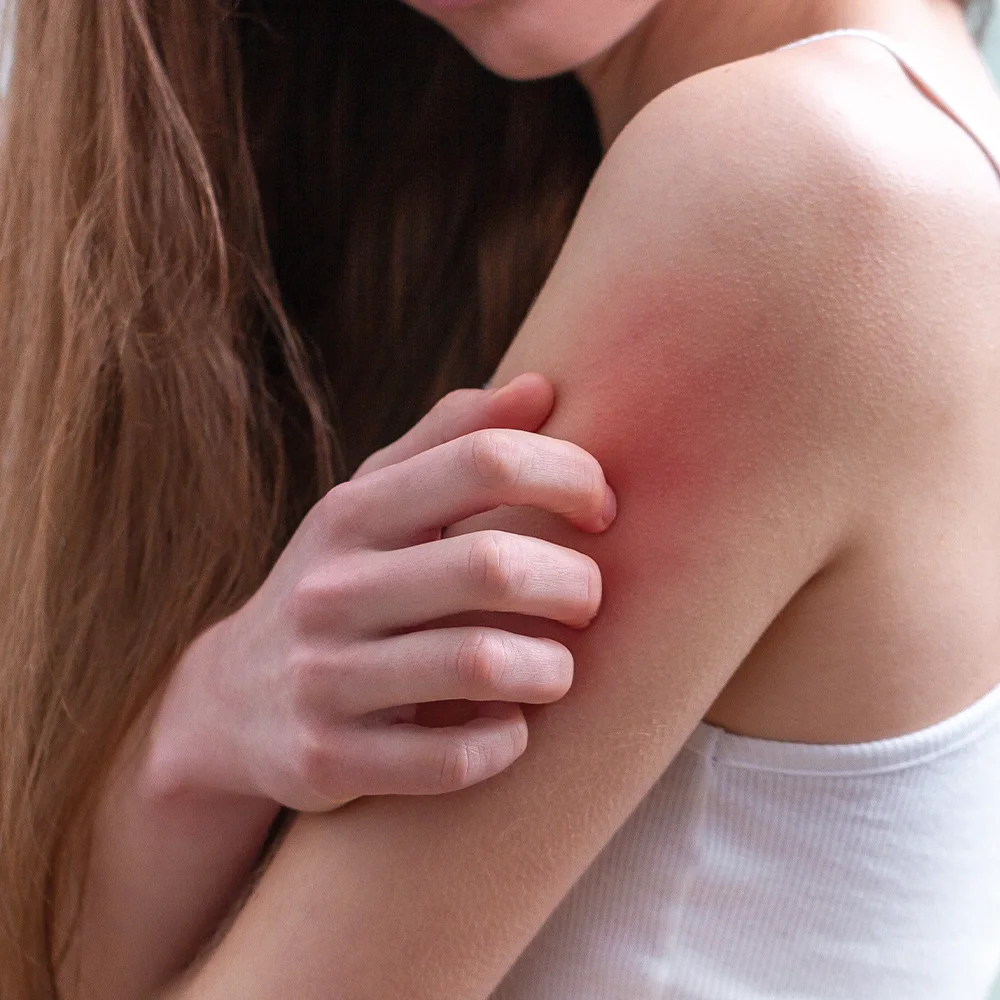 Scabies: symptoms, treatment, and more - Desktop Image