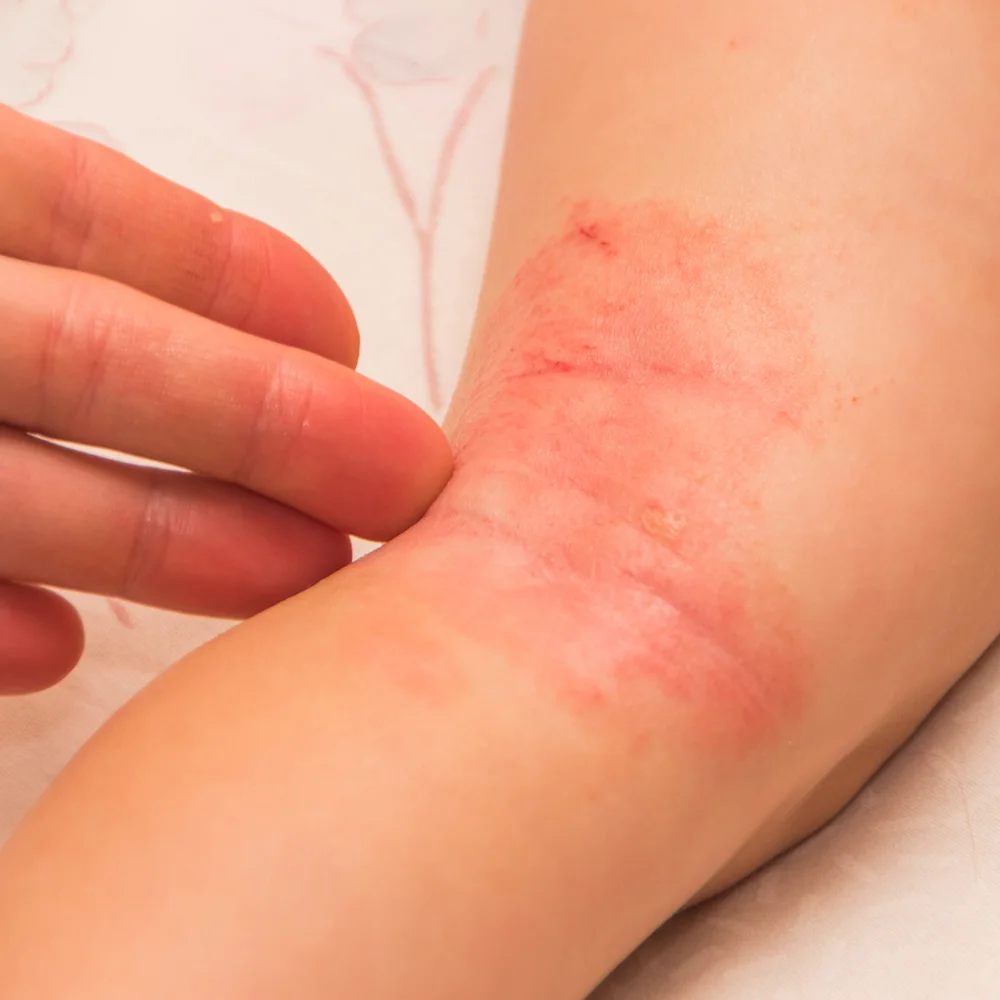 Inverse psoriasis: what is it, symptoms, causes, and treatment - Desktop Image