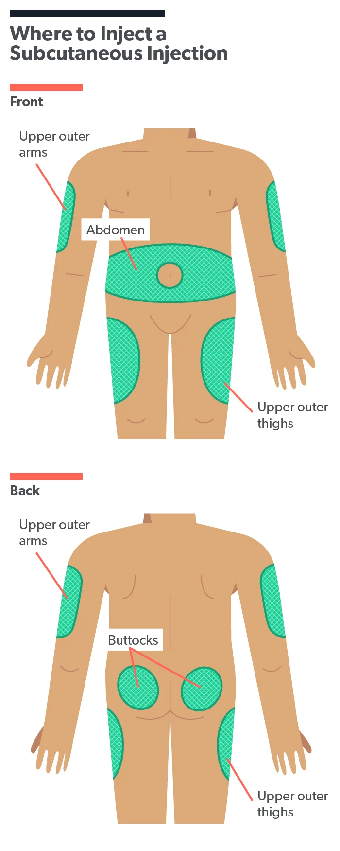 OC Subcutaneous injection: what is it and how to give one image 5af939fe-0400-43e1-9242-fcc9f1c44650