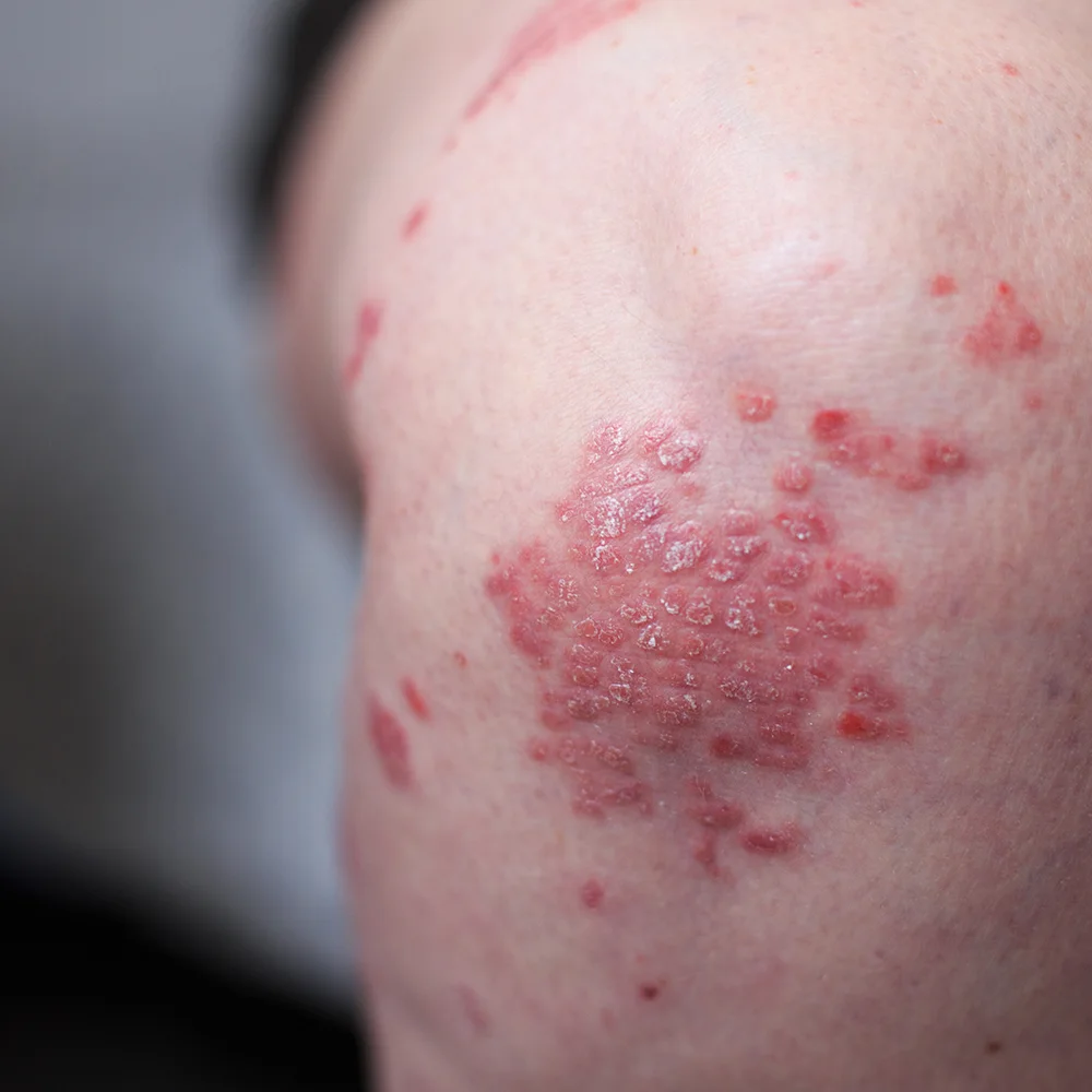 Guttate psoriasis: what is it, symptoms, treatment - Desktop Image