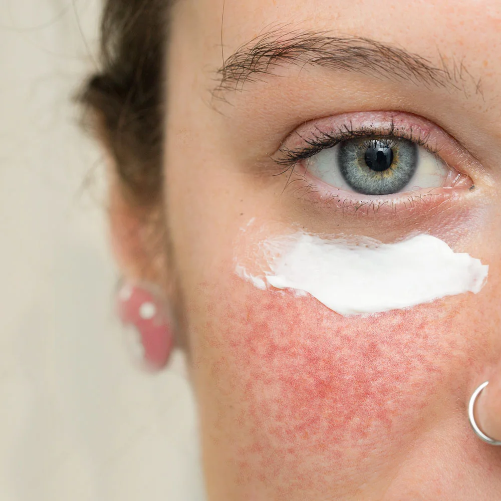 Azelaic acid: benefits, side effects, what does it do - Desktop Image