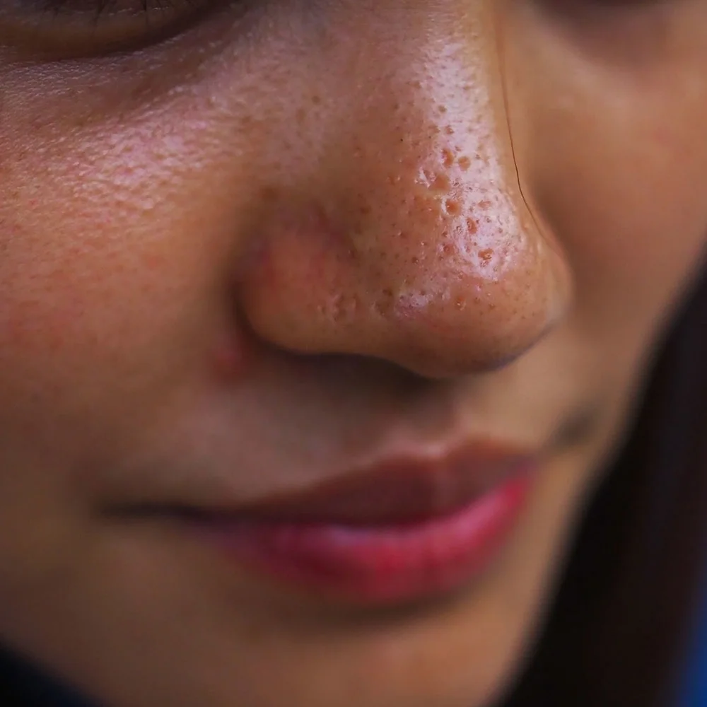 Oily skin: causes, prevention, treatments, and home remedies - Desktop Image