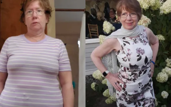 GLP-1 medications for weight loss before and after photo