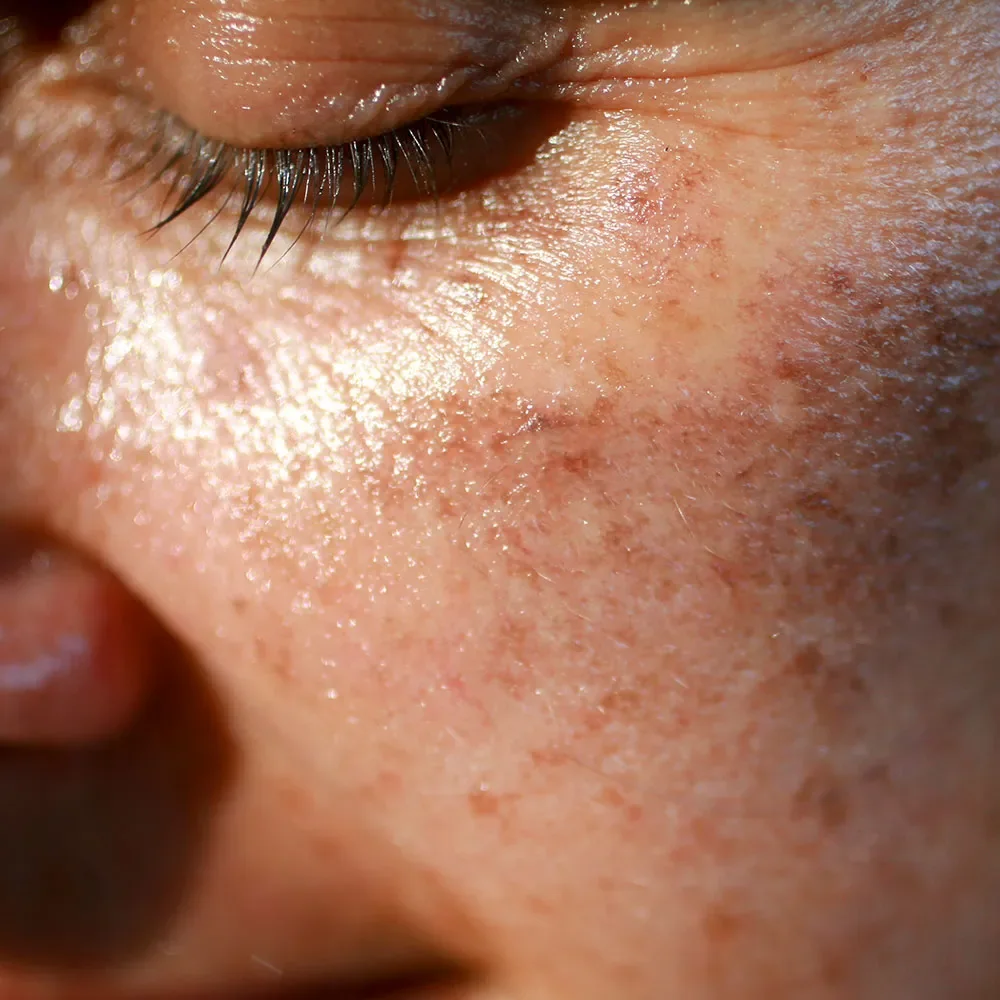 Sunspots on skin: what are they, causes, treatment, and removal - Desktop Image