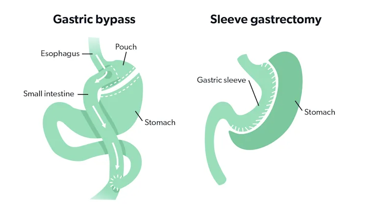 Plenity and weight loss