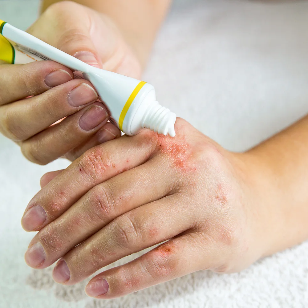 Pustular psoriasis: what is it, symptoms, types, and treatment - Desktop Image