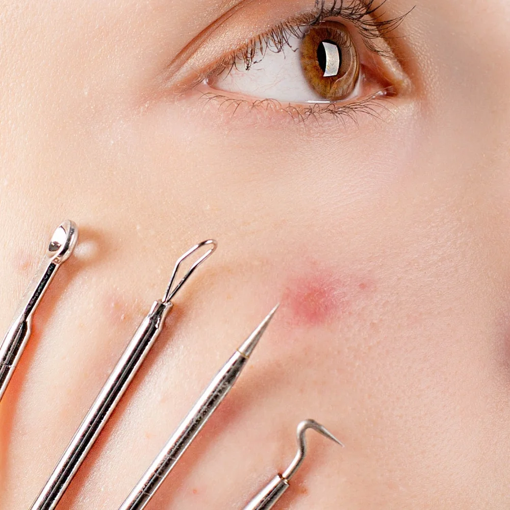 PCOS acne: causes and treatments - Desktop Image