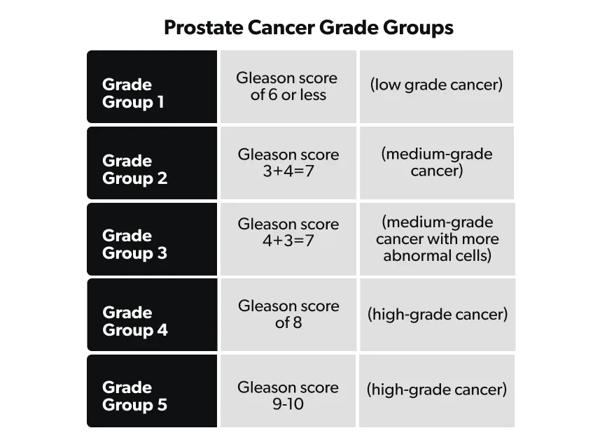 OC Prostate cancer: stages, grades, and treatment image 85bdb4d9-b746-44cb-9c94-3c60f744aa58