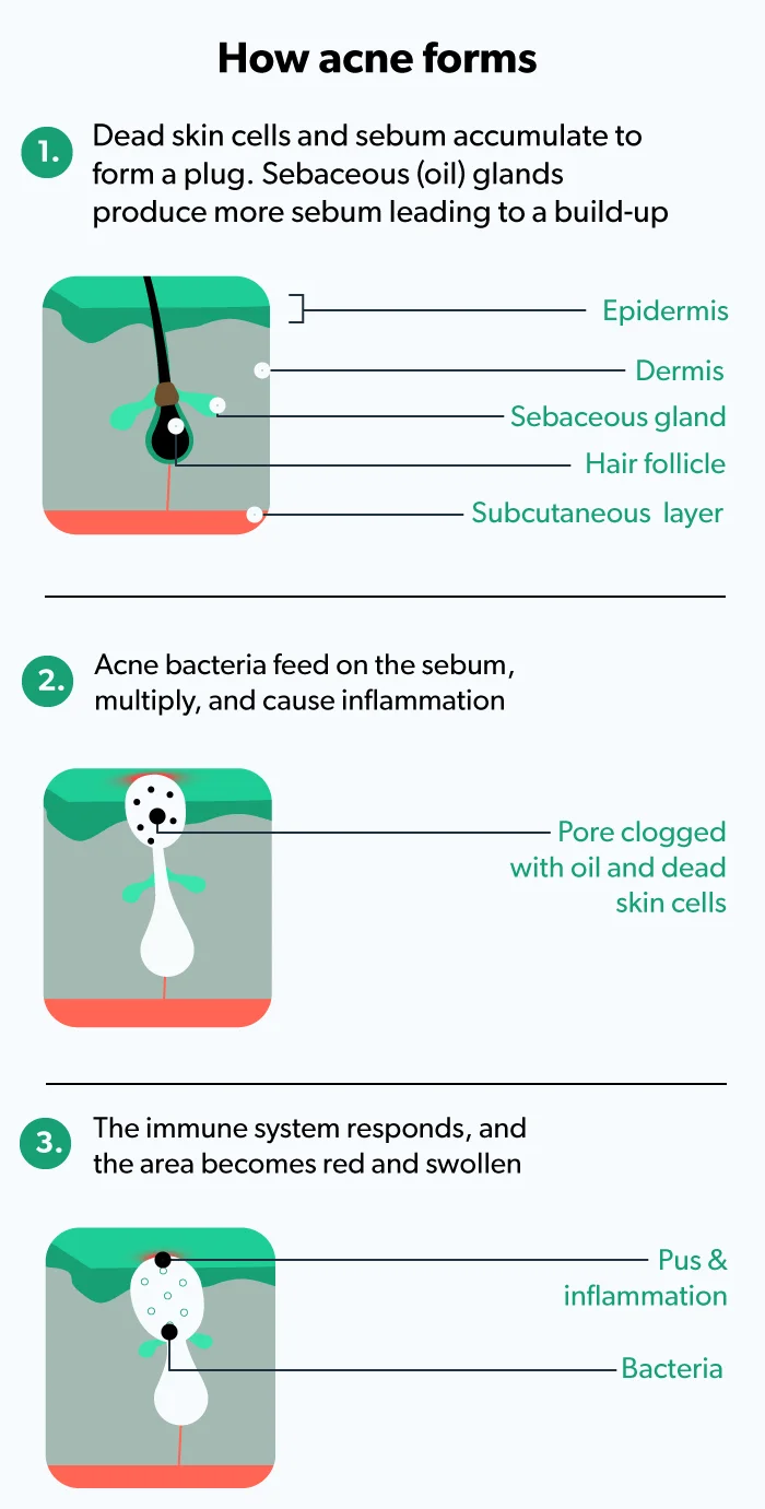 OC Body acne: causes, treatments, how to get rid of it image 988017b7-f160-4976-b7d4-7a85e0bff85e