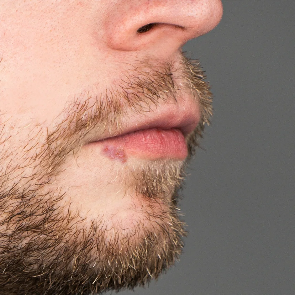 Cold sores and oral herpes: causes, symptoms and treatment - Desktop Image