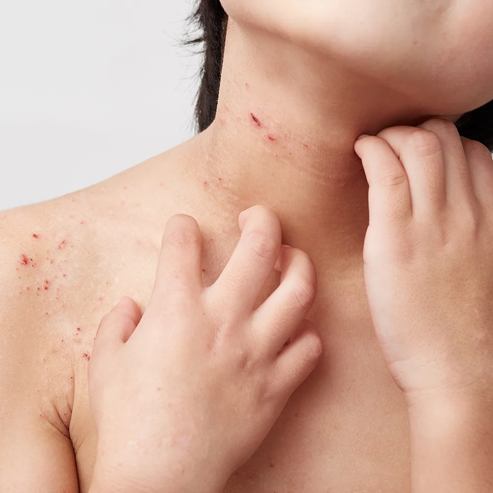 Acyclovir: uses, side effects, interactions, and dosage - Desktop Image