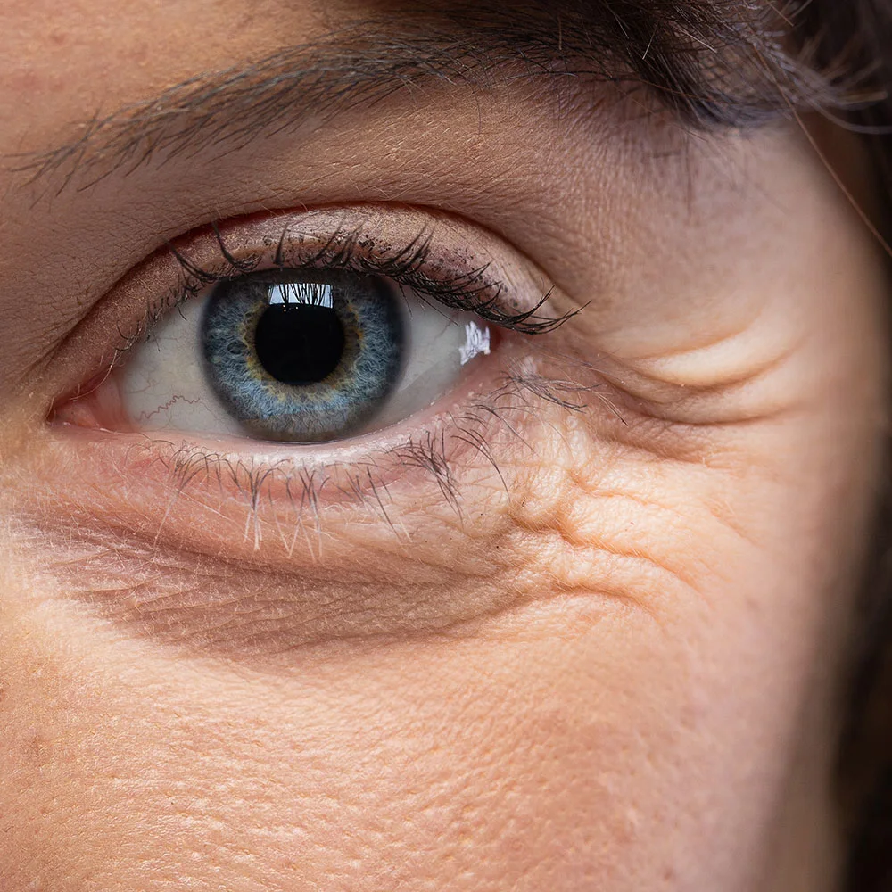 Crow’s feet: what are they, treatment, prevention - Desktop Image