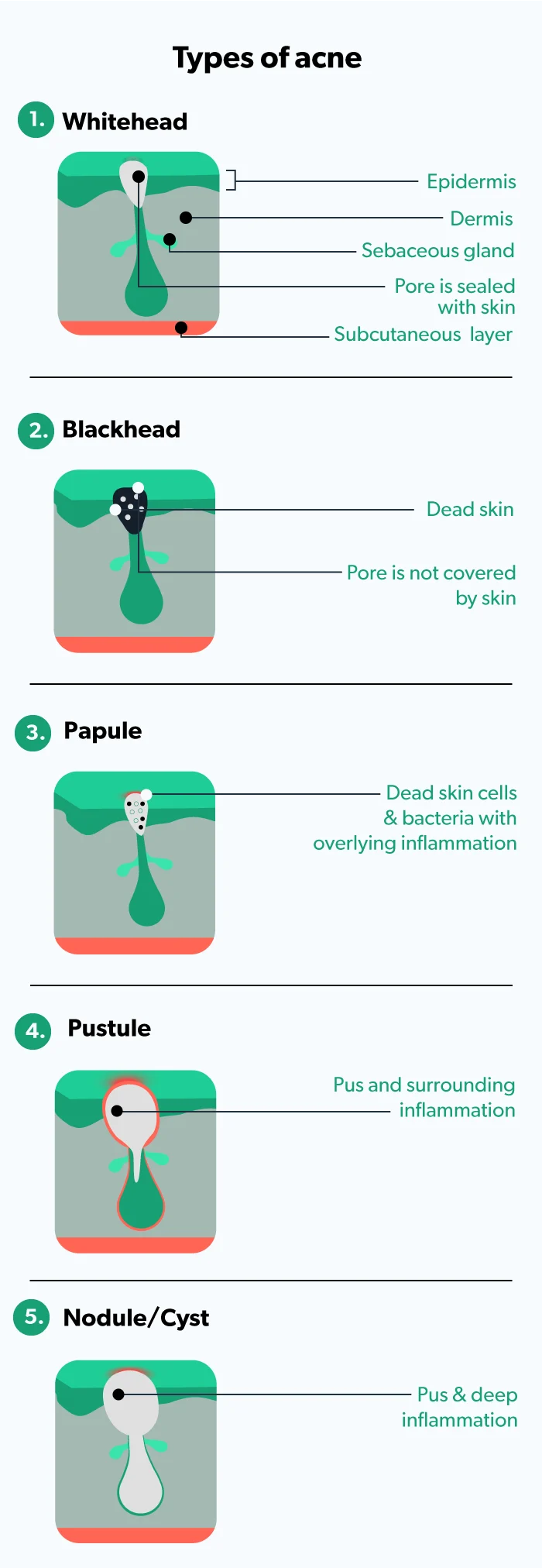 OC Body acne: causes, treatments, how to get rid of it image eb553180-2fad-48f5-81c6-43ca2f12cc78