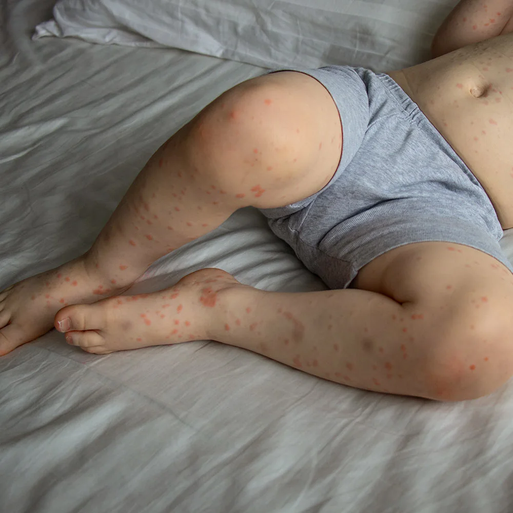 Human Herpesvirus 6 (HHV-6): transmission and symptoms - Desktop Image